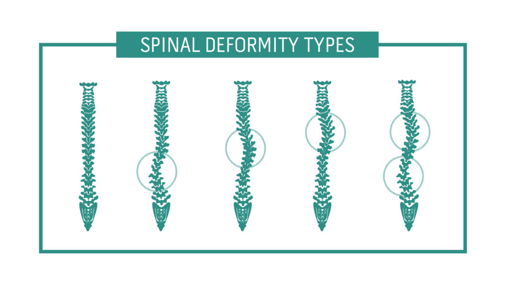 Spinal deformity types